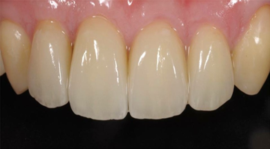 بعد تجميل الاسنان والحشوات التجميل 5